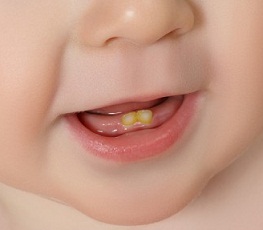 دندانپزشکی کودکان و اطفال در مشهد