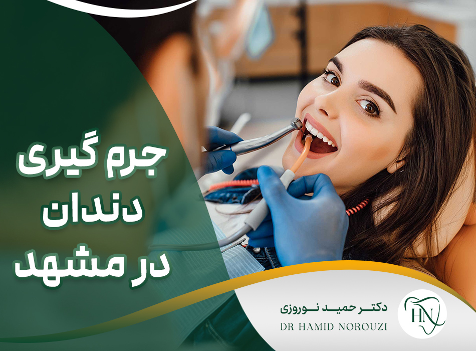 جرمگیری دندان در مشهد