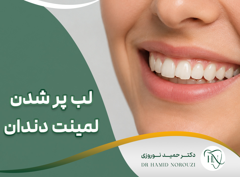 لب پر شدن لمینت دندان